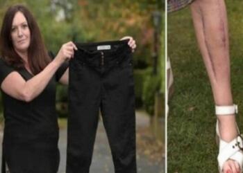 52χρονη χόρευε σε ένα πάρτι όταν λιποθύμησε ξαφνικά. Μόλις οι γιατροί πρόσεξαν λίγο καλύτερα το παντελόνι της. Πάγωσαν…