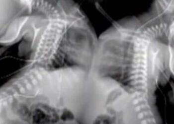 Έγκυος έκανε υπερηχογράφημα – Όταν το είδαν οι γιατροί πάγωσαν και της είπαν να το ρίξει