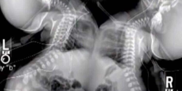 Έγκυος έκανε υπερηχογράφημα – Όταν το είδαν οι γιατροί πάγωσαν και της είπαν να το ρίξει