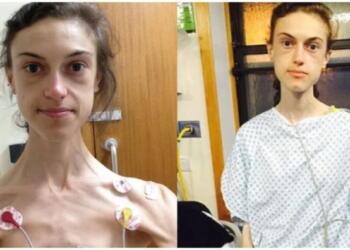 Κοπέλα που αρνούνταν την τροφή και ζύγιζε 31 κιλά, σήμερα είναι μια κούκλα χάρη στο Instagram