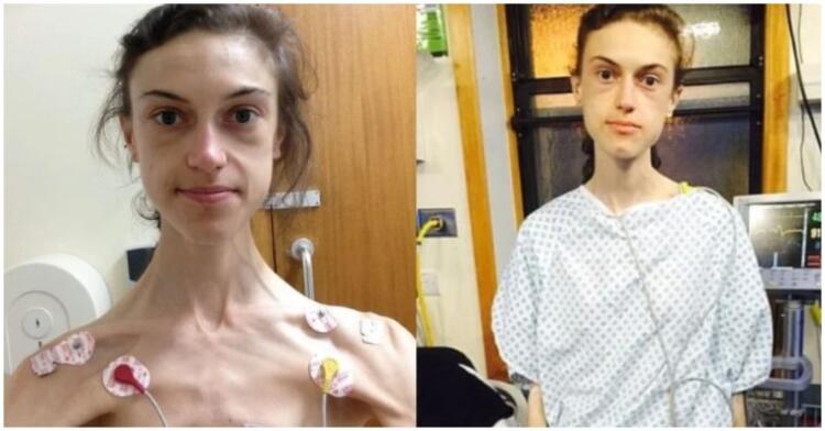 Κοπέλα που αρνούνταν την τροφή και ζύγιζε 31 κιλά, σήμερα είναι μια κούκλα χάρη στο Instagram