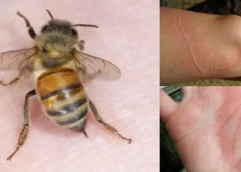 Σας τσιμπήσε σκορπιός, σφήκα, μέλισσα, φίδι; Δείτε τι πρέπει να κάνετε;