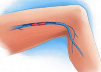 Θρόμβωση: Επτά ύπουλα σημάδια που δεν πρέπει να αγνοήσετε