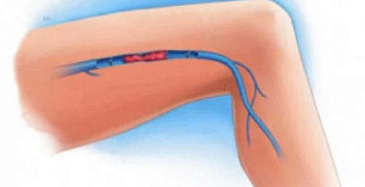 Θρόμβωση: Επτά ύπουλα σημάδια που δεν πρέπει να αγνοήσετε
