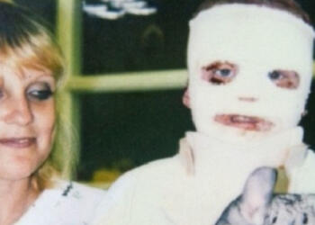 ΜΕΓΑΛΕΙΟ ΨΥΧΗΣ! Στα 6 του χρόνια κάηκε το 70% του σώματός του! Σήμερα όμως, δείτε τι κάνει…