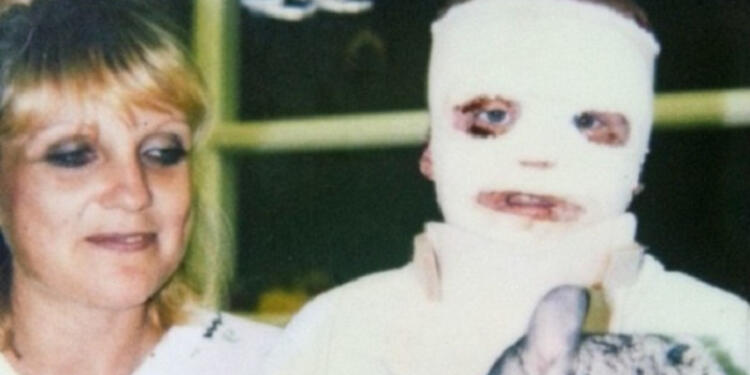 ΜΕΓΑΛΕΙΟ ΨΥΧΗΣ! Στα 6 του χρόνια κάηκε το 70% του σώματός του! Σήμερα όμως, δείτε τι κάνει…