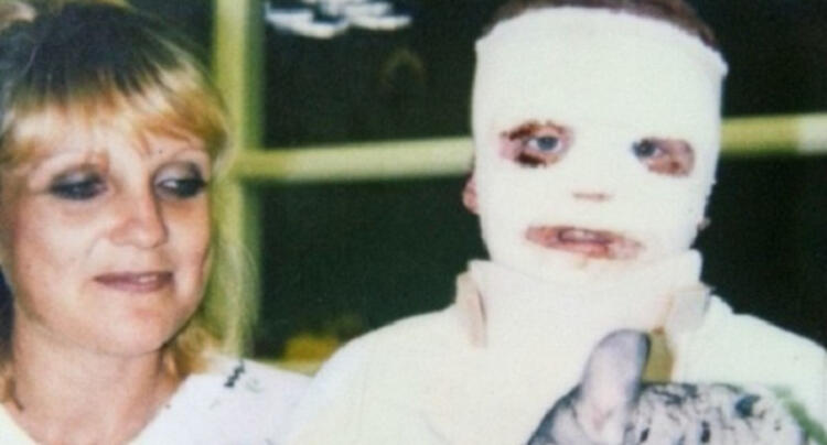 ΜΕΓΑΛΕΙΟ ΨΥΧΗΣ! Στα 6 του χρόνια κάηκε το 70% του σώματός του! Σήμερα όμως, δείτε τι κάνει…