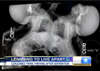 27χρονη έγκυος πήγε να κάνει υπερηχογράφημα – Όταν το είδαν οι γιατροί πάγωσαν και της είπαν..