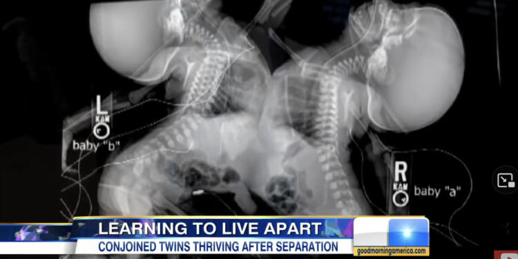 27χρονη έγκυος πήγε να κάνει υπερηχογράφημα – Όταν το είδαν οι γιατροί πάγωσαν και της είπαν..