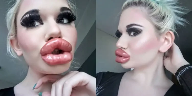 Φοιτήτρια από την Βουλγαρία εθισμένη στα προθέματα έκανε τα χείλια της τεράστια μοιάζει με πάπια και λέει πως είναι κουκλάρα