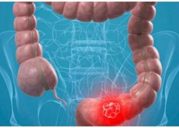 Το όσπριο που προστατεύει από καρκίνο του παχέος εντέρου