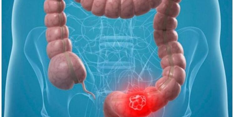 Το όσπριο που προστατεύει από καρκίνο του παχέος εντέρου