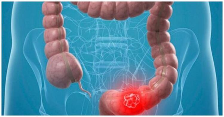 Το όσπριο που προστατεύει από καρκίνο του παχέος εντέρου