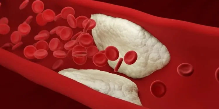 Φραγμένες αρτηρίες: Αυτές είναι οι 12 απαγορευμένες τροφές