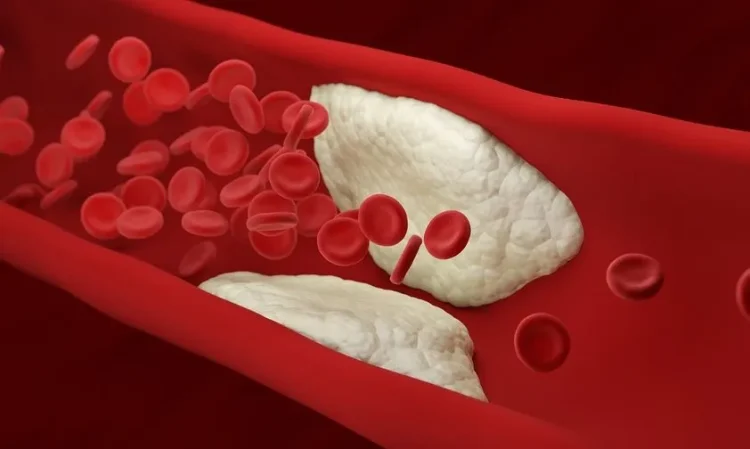 Φραγμένες αρτηρίες: Αυτές είναι οι 12 απαγορευμένες τροφές