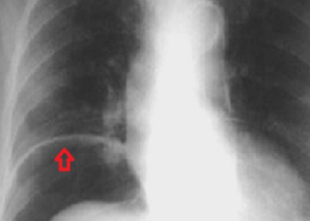 Πονούσε στην κοιλιά, πήγε στο νοσοκομείο και οι γιατροί έπαθαν ΣΟΚ με αυτό που είδαν..