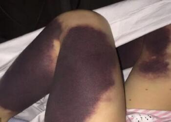 Ξύπνησε γεμάτη μώλωπες – Ήταν η αρχή του Γολγοθά της