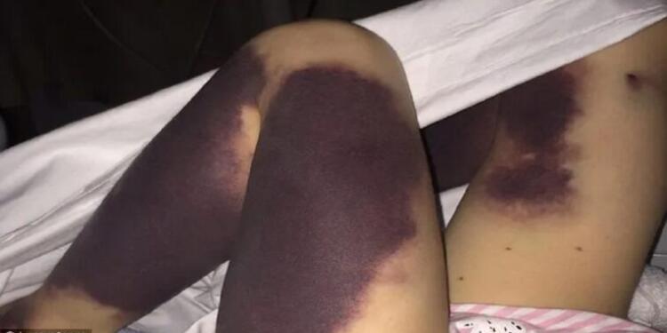 Ξύπνησε γεμάτη μώλωπες – Ήταν η αρχή του Γολγοθά της