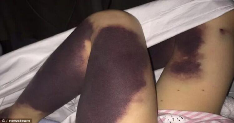 Ξύπνησε γεμάτη μώλωπες – Ήταν η αρχή του Γολγοθά της