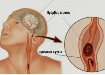 Tι πρέπει να κάνουμε σε περίπτωση εγκεφαλικού: Σώζει ζωές και παίρνει μόνο 1 λεπτό για να το διαβάσετε
