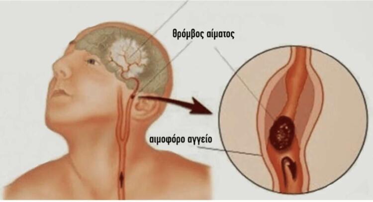 Tι πρέπει να κάνουμε σε περίπτωση εγκεφαλικού: Σώζει ζωές και παίρνει μόνο 1 λεπτό για να το διαβάσετε