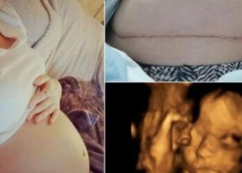 26χρονη μητέρα γέννησε πρόωρα μωρό – Αυτό που έκαναν μετά οι γιατροί θα σας αφήσει άφωνους