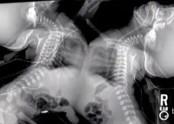 Όταν είδαν οι Γιατροί το Υπερηχογράφημα Χωρίς δεύτερη σκέψη, της είπαν να τα «ρίξει».