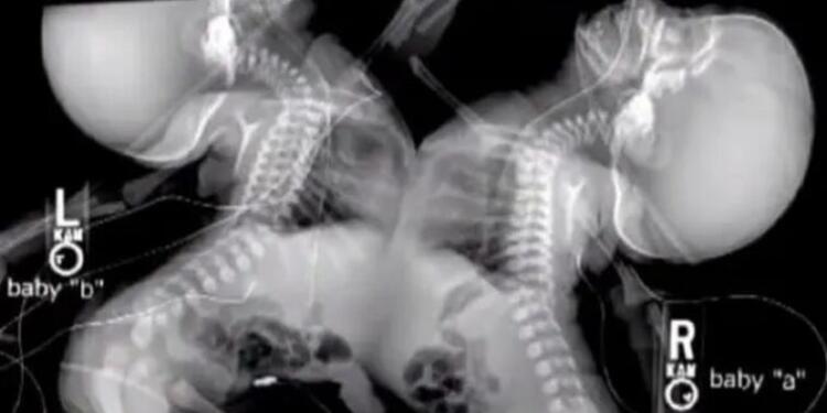 Όταν είδαν οι Γιατροί το Υπερηχογράφημα Χωρίς δεύτερη σκέψη, της είπαν να τα «ρίξει».