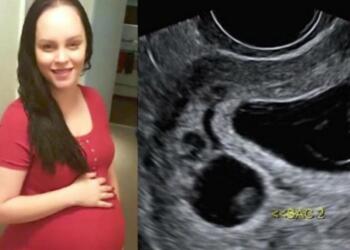 31χρονη έμεινε έγκυος σε δίδυμα – Αλλά το ένα δεν είναι δικό της παιδί! (Video)