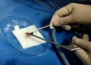 Άνδρας πήγε στο νοσοκομείο με αιμορραγία στη μύτη, αυτό που βρήκαν οι γιατροί τους σόκαρε! (photo)