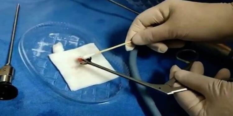 Άνδρας πήγε στο νοσοκομείο με αιμορραγία στη μύτη, αυτό που βρήκαν οι γιατροί τους σόκαρε! (photo)