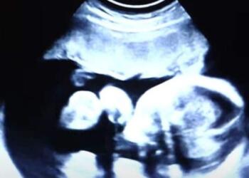 52χρονη είναι έγκυος στα δίδυμα παιδιά του γαμπρού της – Όταν όμως οι γιατροί είδαν τον τελευταίο υπέρηχο «πάγωσαν» (Video)