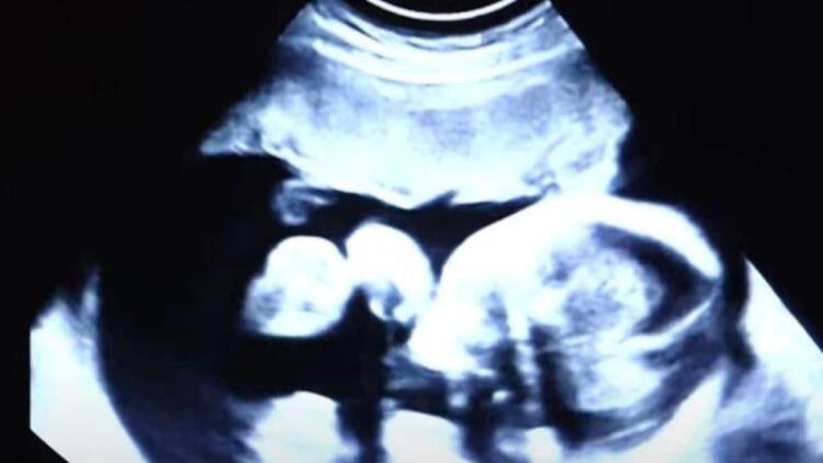 52χρονη είναι έγκυος στα δίδυμα παιδιά του γαμπρού της – Όταν όμως οι γιατροί είδαν τον τελευταίο υπέρηχο «πάγωσαν» (Video)