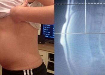 Νόμιζαν ότι αυτή η 17χρονη έφηβη ήταν έγκυος… Όταν όμως οι γιατροί είδαν την αξονική της «πάγωσαν»