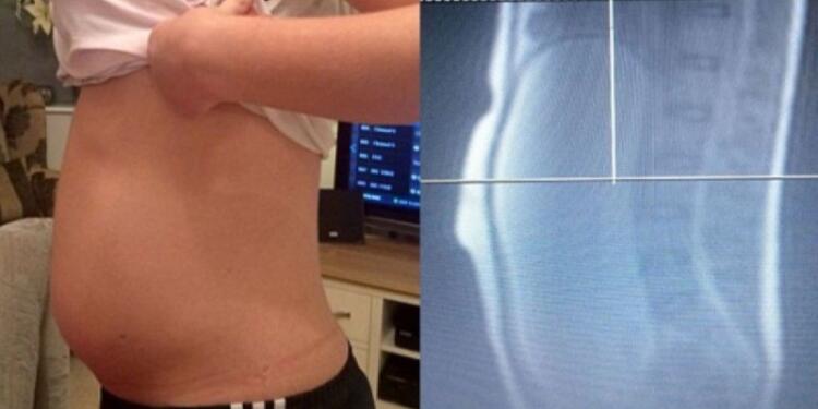 Νόμιζαν ότι αυτή η 17χρονη έφηβη ήταν έγκυος… Όταν όμως οι γιατροί είδαν την αξονική της «πάγωσαν»