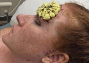 39χρονη έμεινε έγκυος και φύτρωσε στο μέτωπό της κάτι παράξενο – Μόλις της το αφαίρεσαν οι γιατροί «πάγωσαν»