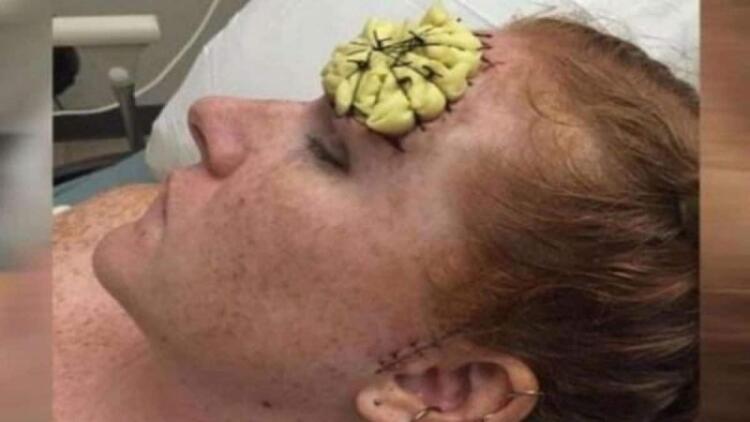 39χρονη έμεινε έγκυος και φύτρωσε στο μέτωπό της κάτι παράξενο – Μόλις της το αφαίρεσαν οι γιατροί «πάγωσαν»