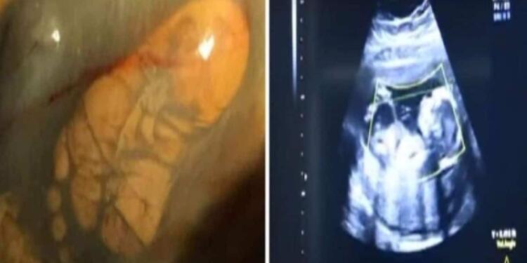 31χρονη ήταν 40 εβδομάδων έγκυος αλλά δεν πήγε ποτέ στον γιατρό για εξετάσεις – Αυτό που έδειξε ο πρώτος υπέρηχος…