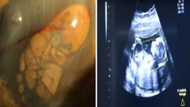 31χρονη ήταν 40 εβδομάδων έγκυος αλλά δεν πήγε ποτέ στον γιατρό για εξετάσεις – Αυτό που έδειξε ο πρώτος υπέρηχος…