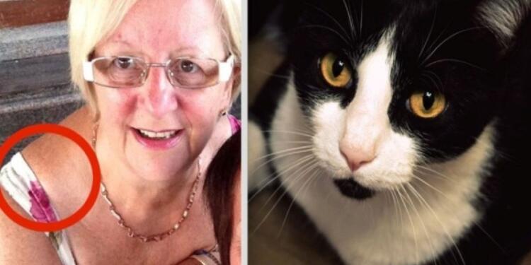 Αυτή η 64χρονη γιαγιά δεν είχε ιδέα τι μεγάλωνε στον ώμο της – Η γάτα της όμως κατάλαβε ότι κάτι δεν πήγαινε καλά