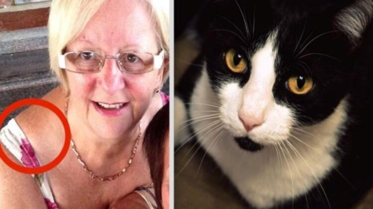 Αυτή η 64χρονη γιαγιά δεν είχε ιδέα τι μεγάλωνε στον ώμο της – Η γάτα της όμως κατάλαβε ότι κάτι δεν πήγαινε καλά