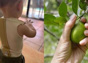 Μητέρα κρούει τον κώδωνα του κινδύνου: Μωρό έπαθε φρικτά εγκαύματα από ένα λεμόνι – «Ξαφνικά είδα σημάδια»