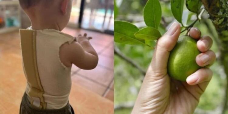 Μητέρα κρούει τον κώδωνα του κινδύνου: Μωρό έπαθε φρικτά εγκαύματα από ένα λεμόνι – «Ξαφνικά είδα σημάδια»