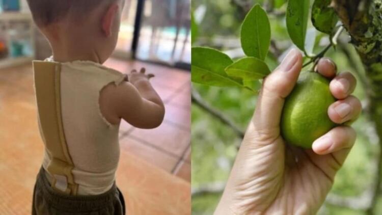 Μητέρα κρούει τον κώδωνα του κινδύνου: Μωρό έπαθε φρικτά εγκαύματα από ένα λεμόνι – «Ξαφνικά είδα σημάδια»