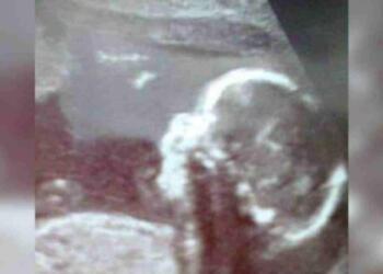 Έγκυος γυναίκα πήγε να δει τον υπέρηχο του μωρού της – Αυτό το που αντίκρισε στην γέννα θα σας σοκάρει