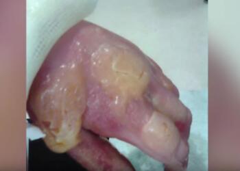 Άγγιξε αυτό το κοινό φυτό, ξεκίνησε να πρήζεται και κατέληξε στην εντατική – Θα μείνετε όταν δείτε ποιο είναι