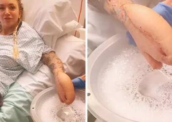 Το «χέρι-καρχαρίας» που σπάει ρεκόρ στο Tik Tok με 75 εκατ. προβολές κρύβει μια τραγική ιστορία από πίσω