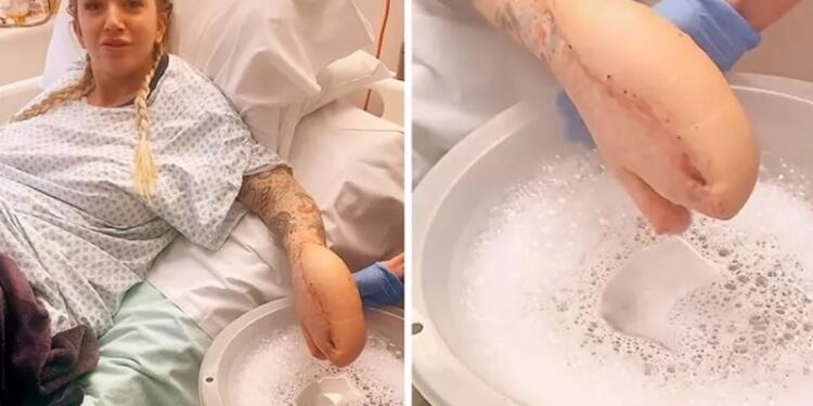 Το «χέρι-καρχαρίας» που σπάει ρεκόρ στο Tik Tok με 75 εκατ. προβολές κρύβει μια τραγική ιστορία από πίσω