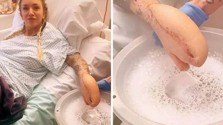 Το «χέρι-καρχαρίας» που σπάει ρεκόρ στο Tik Tok με 75 εκατ. προβολές κρύβει μια τραγική ιστορία από πίσω