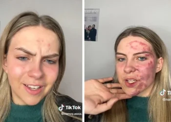 Γυναίκα γέμισε μώλωπες στο πρόσωπο από ένα σπυράκι ‑ Οι γιατροί δεν μπορούν να κάνουν τίποτα